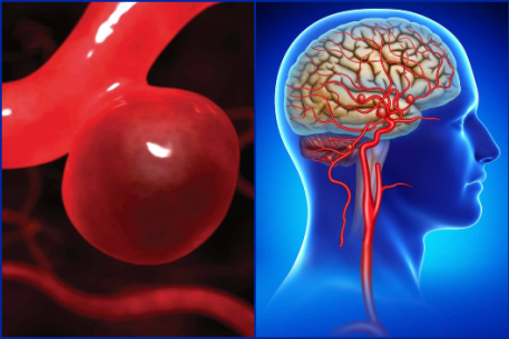 Phình mạch máu não có thể gây đột quỵ não