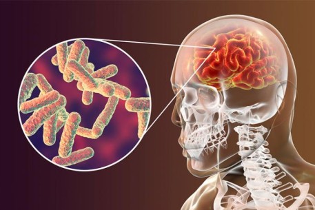 Bệnh Lao màng não: Nguyên nhân và cách phòng ngừa