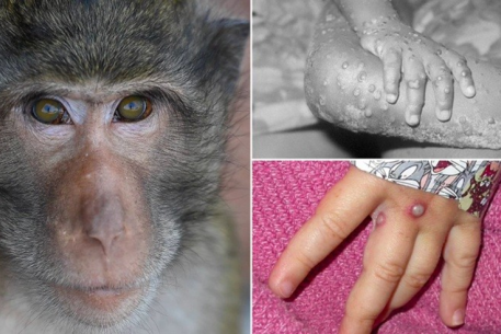 Cần biết: 6 biện pháp phòng chống dịch bệnh đậu mùa khỉ