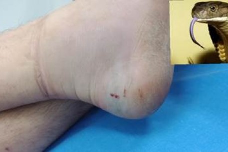 Xử lý khi bị rắn cắn