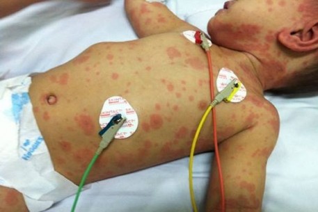 Chủ động phòng bệnh não mô cầu theo khuyến cáo của Bộ Y tế