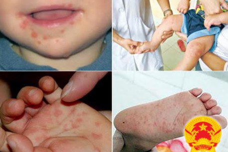 Phân biệt bệnh thuỷ đậu và bệnh tay chân miệng và cách phòng ngừa