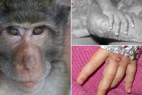 Bệnh đậu mùa khỉ: các chuyên gia đặt tên mới cho các biến thể virus