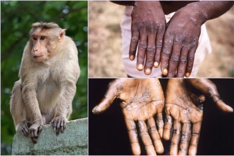 Bệnh Đậu mùa khỉ ở trẻ em và biện pháp phòng ngừa