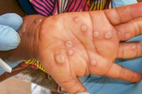 Phân biệt bệnh Đậu mùa khỉ với các bệnh có phỏng nước trên da