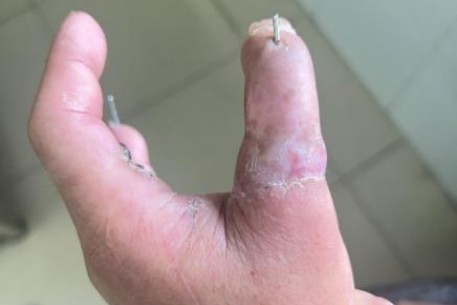 Bệnh viện Đà Nẵng: Phẫu thuật cái hoá thành công ngón tay bị đứt lìa