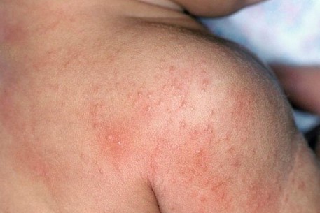 Làm gì với những bệnh ngoài da thường gặp vào mùa nắng nóng?