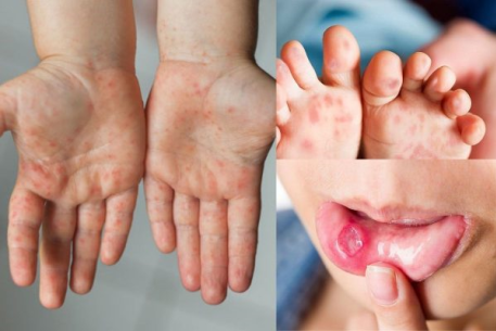 Tăng cường phòng chống bệnh tay chân miệng ở trẻ