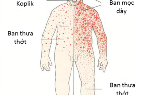 Bệnh Sởi tăng cao ở nhiều địa phương, cần tích cực phòng ngừa