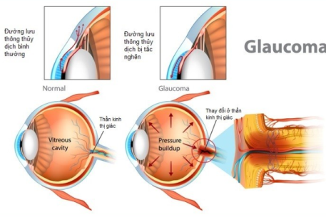 Glocom bẩm sinh – Cần phát hiện sớm để bảo vệ thị lực của trẻ