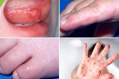 Đà Nẵng tăng cường hành động phòng, chống dịch bệnh mùa cao điểm: Sốt Xuất Huyết, Tay Chân Miệng và COVID-19"