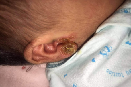 Bấm lỗ tai ngay sau sinh: những nguy cơ phụ huynh cần biết  cho sức khỏe trẻ sơ sinh