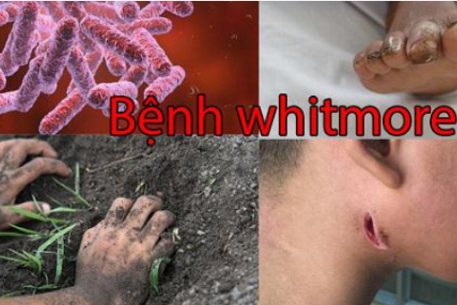 Whitmore – bệnh nguy hiểm từ đất và nước bẩn: Nhận biết và phòng ngừa