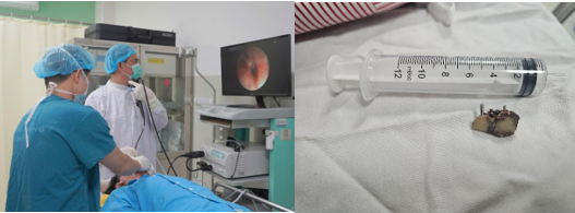 Các bác sĩ đã tiến hành nội soi và lấy ra 2 chiếc răng giả 