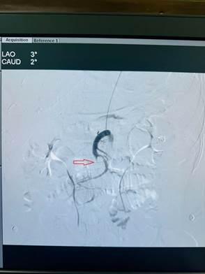 : Huyết khối gây tắc phần lớn động mạch mạc treo tràng trên và các nhánh