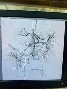 Động mạch mạc treo tràng trên được can thiệp tái thông