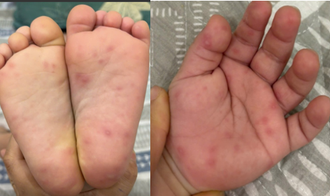  Bệnh TCM gia tăng nhất là ở trẻ nhỏ